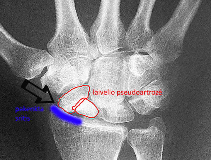 artrozė iš pėdos su plokščiapėdiškumas sąnarių
