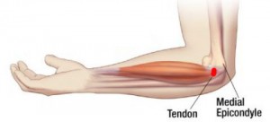 kas yra artrozė ir kaip ją gydyti skausmas peties sąnario kairės rankos po kritimo