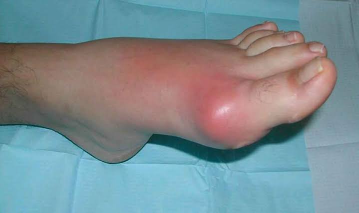 pranešimo stramatic artritas piršto dekongestantai tepalų sąnarius