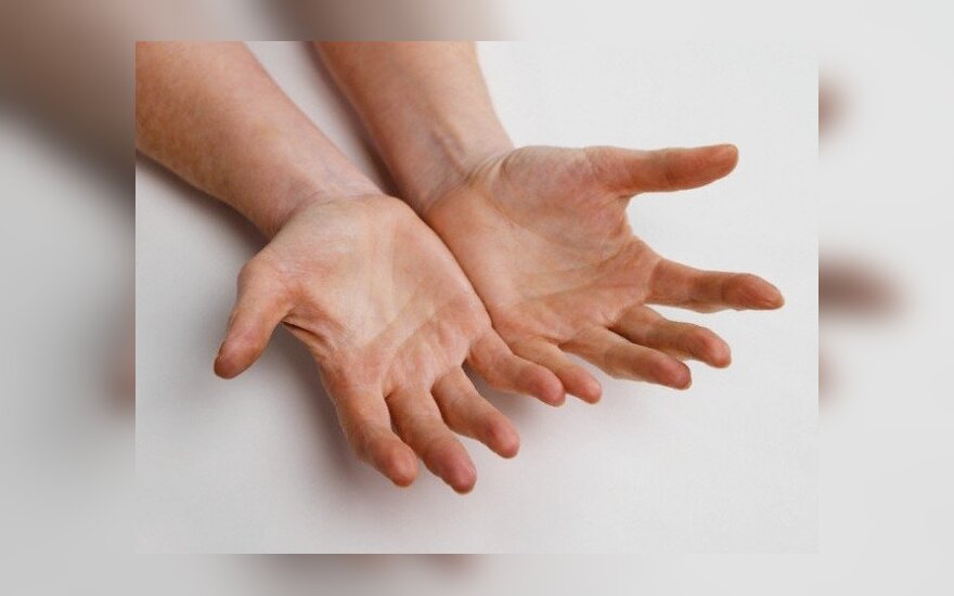 gydymas artrito namie ant rankų pirštų iš peties sąnario gydymo