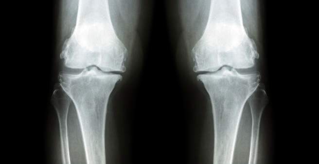 sytina nuotaikos osteoartrito gydymui