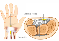 rankų riešo sąnarys artritas mažų sąnarių šepečiai