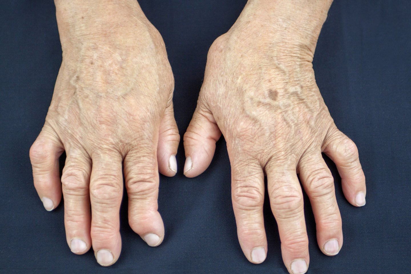 nepilnamečių reumatoidinis artritas su sąnarių uždegimu sausgyslės tendinozė