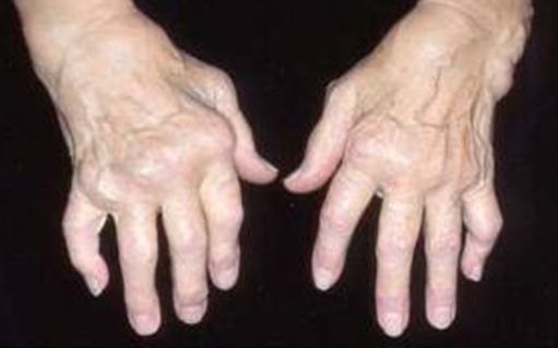 gydymo artrito rankų
