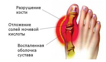 kas yra artrozė 2 laipsnių peties sąnario