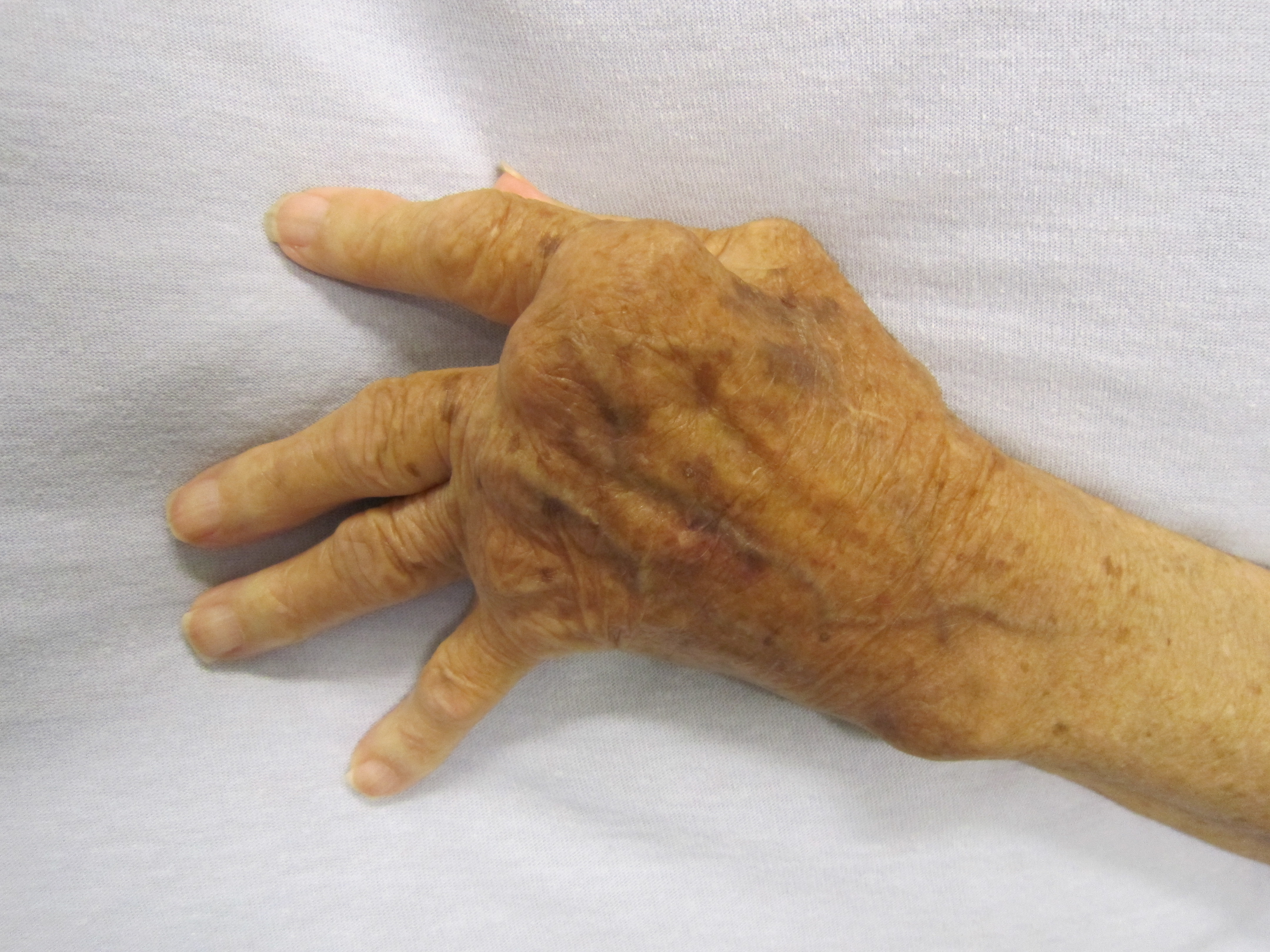 reumatoidinis artritas wiki skausmas priežasties pirštų sąnariuose