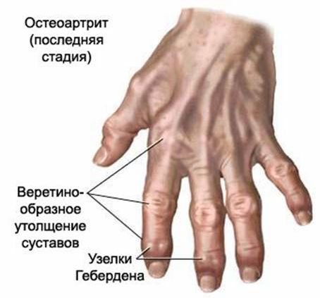 stiprus skausmas rankas rankų sąnarių