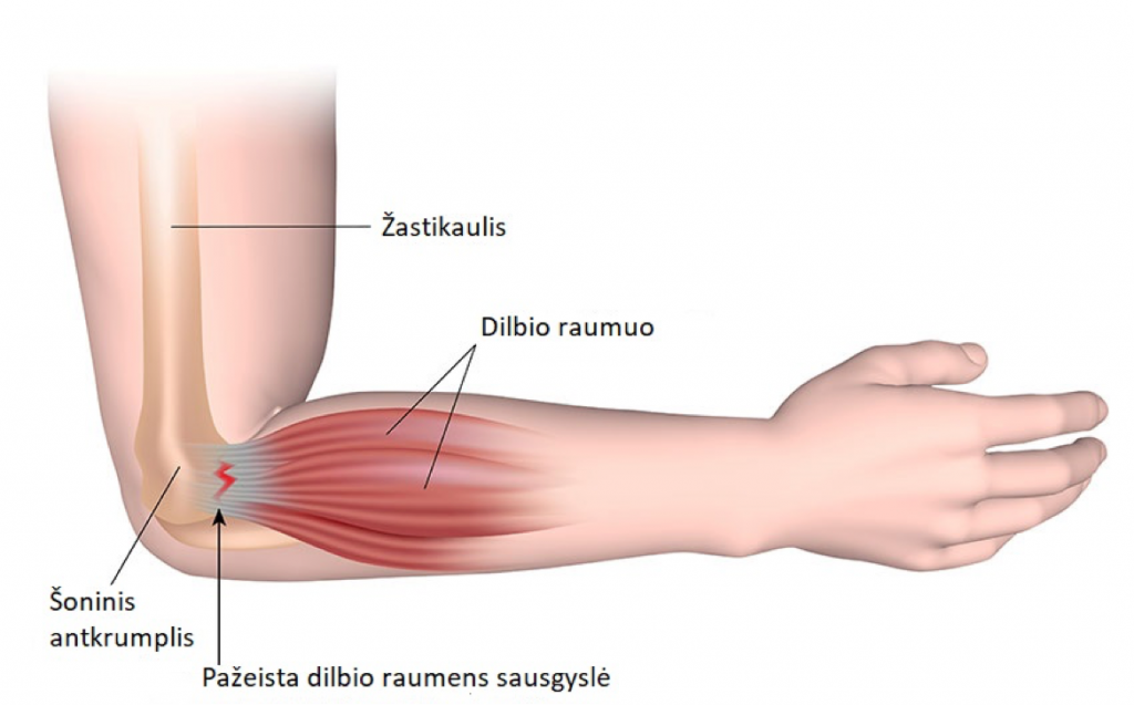 skauda alkūnės sąnario artrozės metu