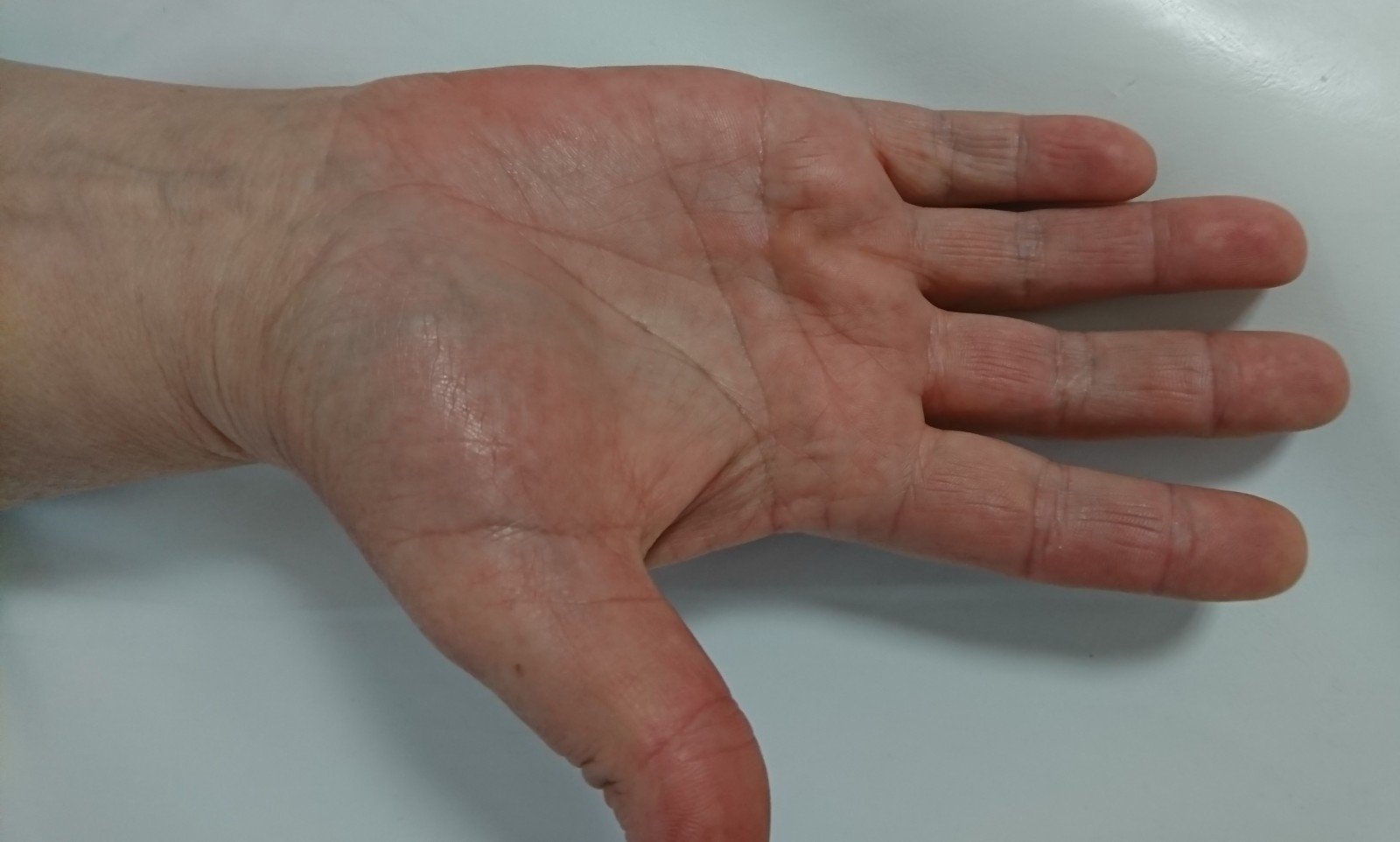 nukrito ant rankos bendra skauda artritas 1 laipsnis peties gydymui