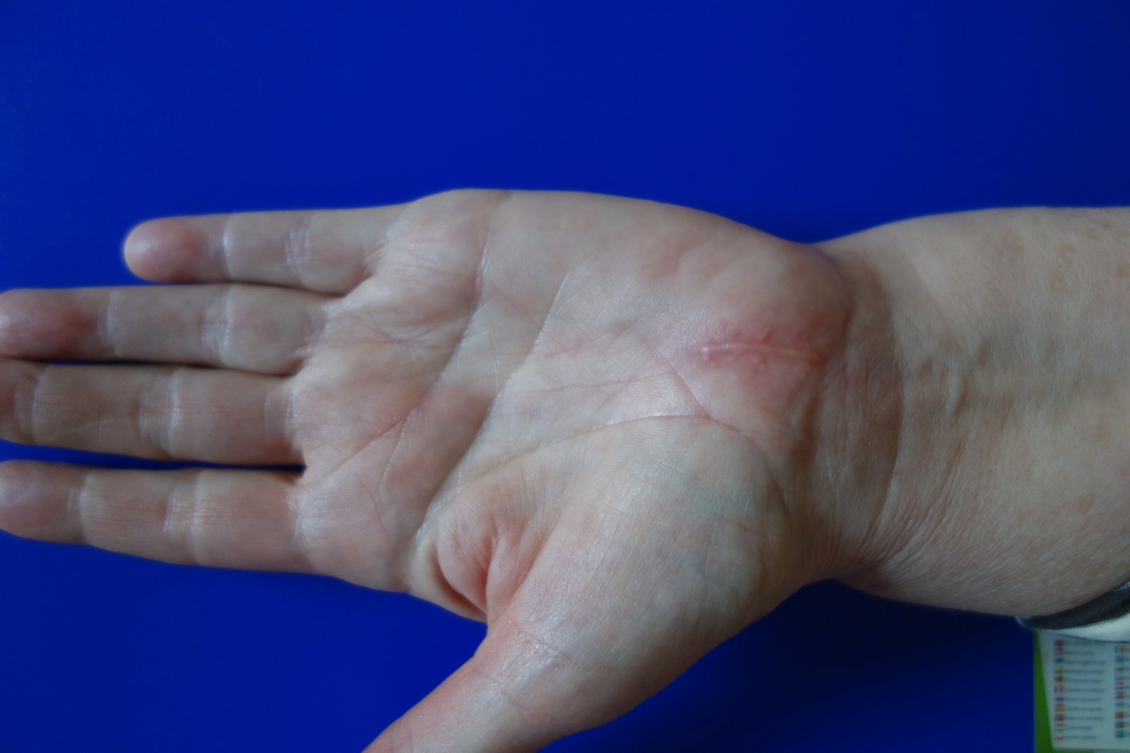 pagalba su jungtimi ant rankų uždegimas šiugždesio sąnarių gydymo rezultatai
