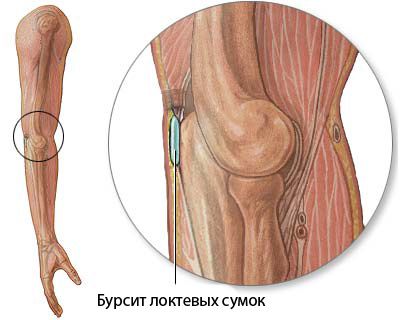 swollen painful joints covid gydymas osteochondrozės ir artrozės