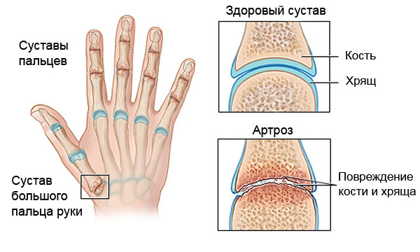 gydymas arthrisa rankų tablečių
