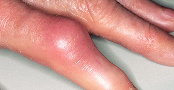 artritas dėl podagros rankas