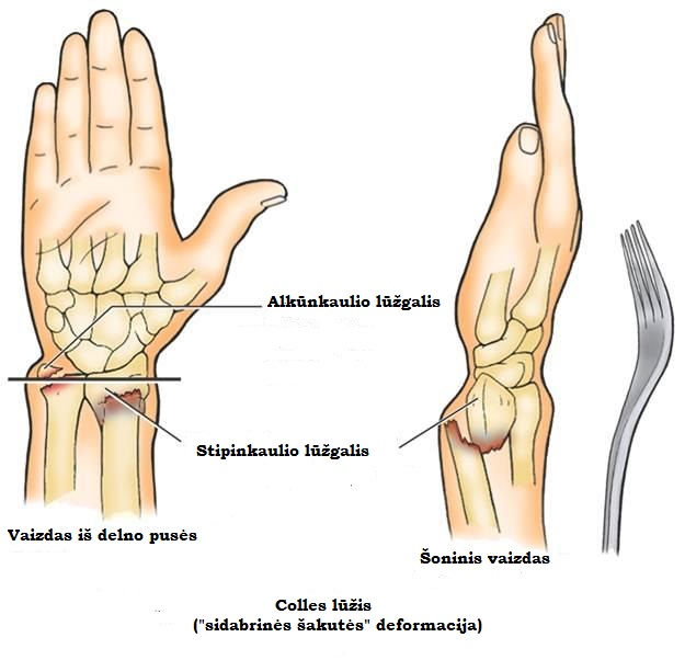 rankų riešo sąnarys gydymo artrozės pečių jungtis