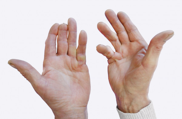 skausmo priežastis atsižvelgiant į mažojo piršto sąnario jei skauda ranka būsto