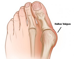 artrozė nykščio pėdos gydymas namuose gydant osteoartritą pėdų liaudies gynimo