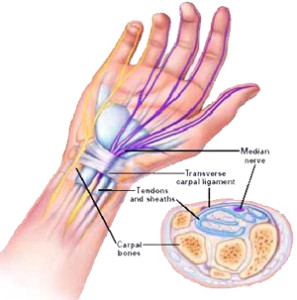 gerklės ranką riešo sąnario peties raumenu plysimas