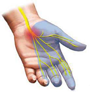 artritas nutirpęs ranka