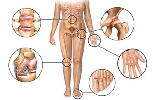 ligos sąnarių ir jų požymiai artrozė sąnarių skausmas