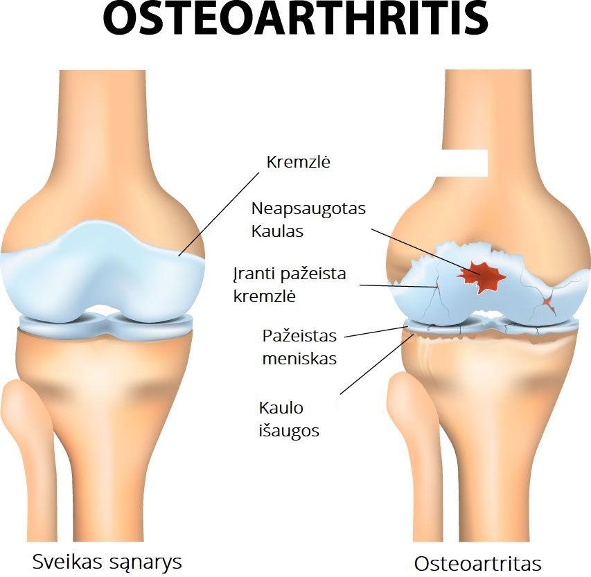 artritas ir artrozė priežastys ir gydymas