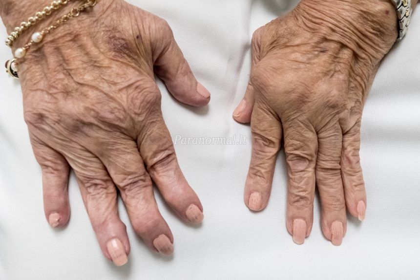 artritas iš priežasčių riešo žandikaulio sąnario skausmas