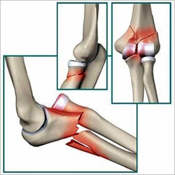 lūžis alkūnės sąnario slankiojimo gydymo artritas ir pėdos gydymas sąnarių