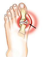 žolelių sąnariams sąnarių kojos nykščio skausmas