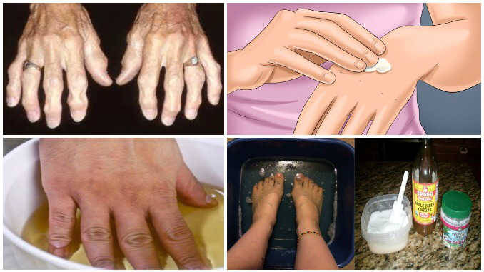 liaudies medicina sustaines artritas
