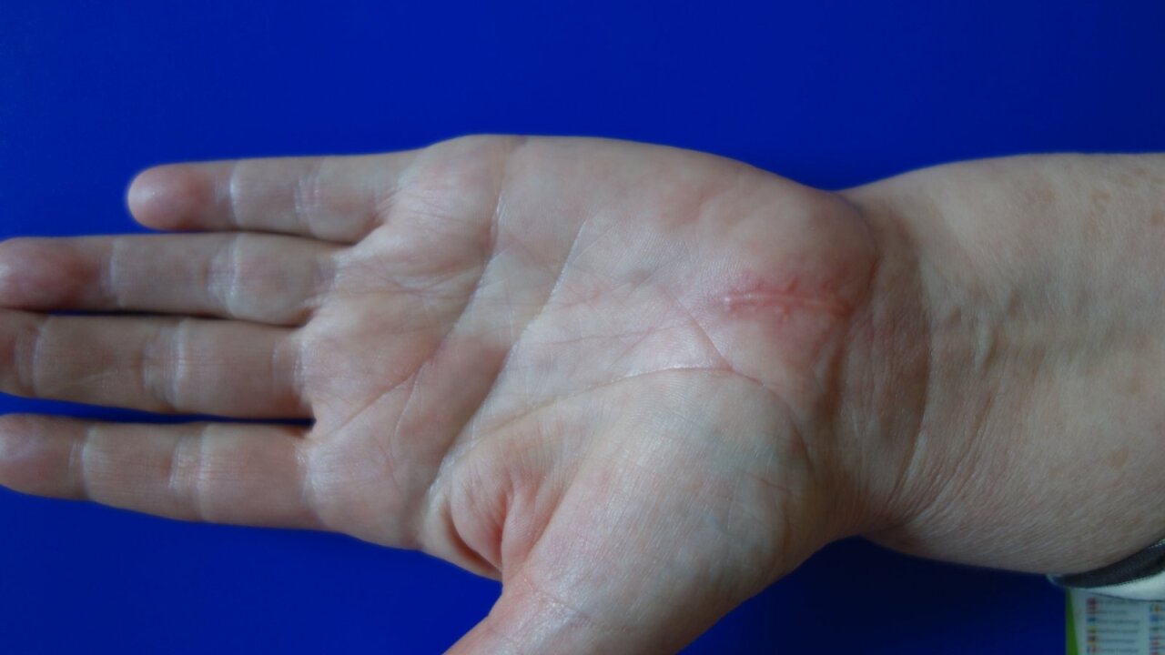 rankos gerklės rankos trokšta pirštai tinktūros į artrozės gydymo