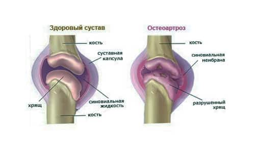 artrozė gydymo pėdų tradiciniai metodai