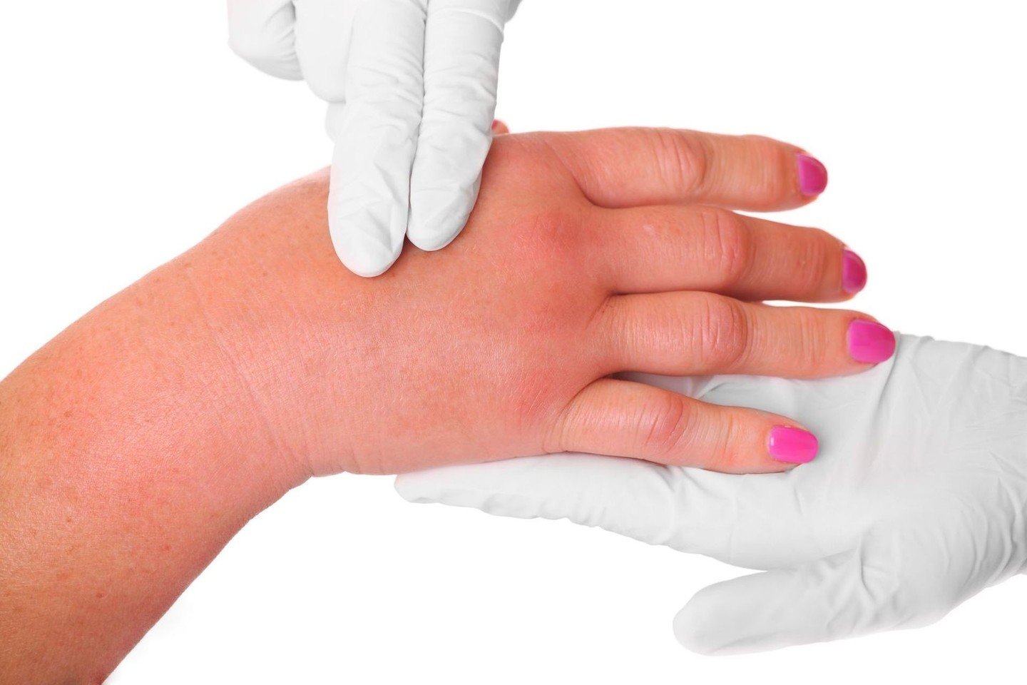 skauda didelių pirštų rankų sąnarius ką daryti agaras gydymas sąnarių