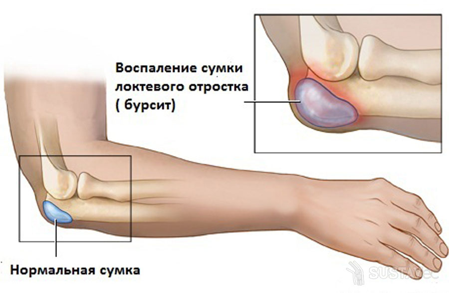 fibromialgija taskai rankos pečių sąnarių ir rankos