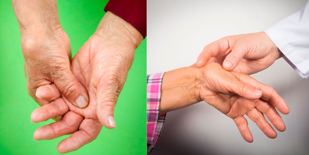 liaudies būdų gydyti artritas artrozės