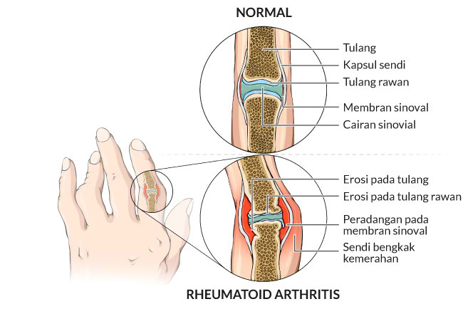 reumatoidinis artritas nei gydyti ar sąnariai skauda osteochondrozės