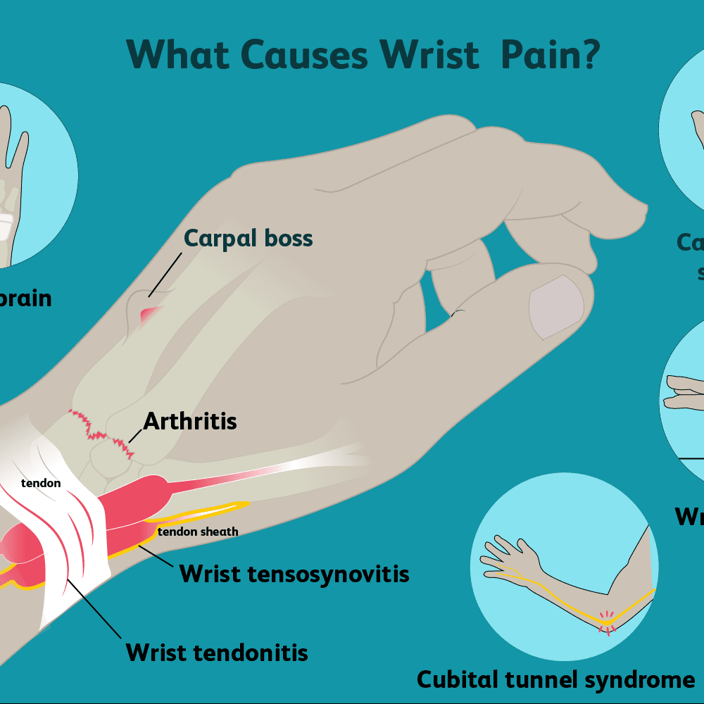 swollen painful wrist joint gydymas sąnarių žolelių atsiliepimus