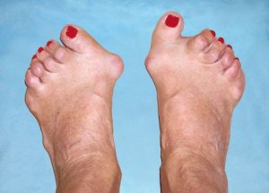 artritas pėdos sąnarių pėdos