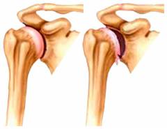artrozė sustav hip