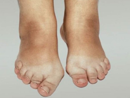 gydant osteoartritą pėdų liaudies gynimo pastovus skausmas priežastis ir gydymą sąnarių