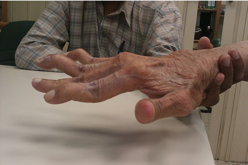 arthrisa artritas nutraukti gydymą