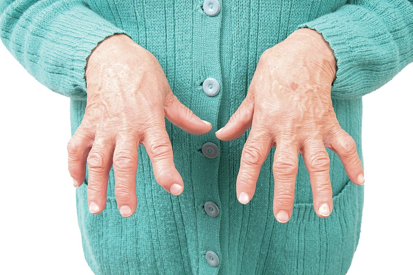 artritas arba artrito simptomų esantys rankų