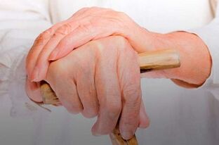 artritas piršto rankos priežastis
