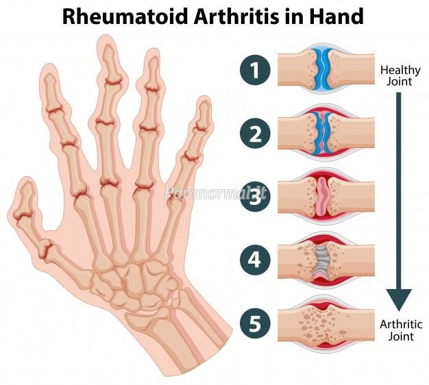 kremzlių artrozės peties sąnario pagal liaudies gynimo reumatoidinis artritas amzius