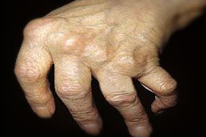 artrito artrozė šepečių rankas