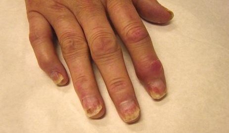 artrito rankas iš piršto liaudies gynimo reumatoidinis artrozė pėdų gydymas