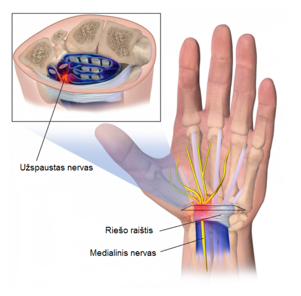 chondroitino gliukozamino mcm artritas nutirpęs ranka
