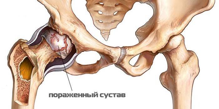 sąnarių pėdos pirštų liaudies medicina artrozė sąnarių