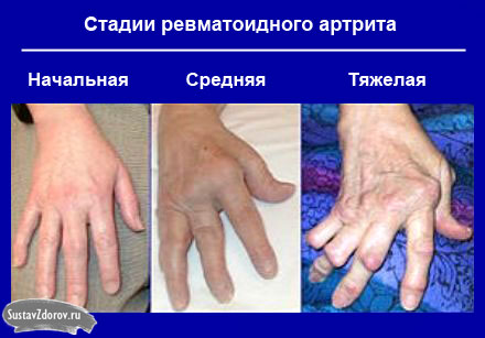 artritas pirštu rankų gydymui