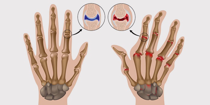gydymo artritas šepetys rankas namuose