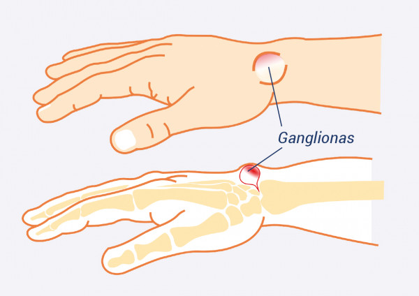 bendras ant rankos rankos skauda skausmas bendrų ir pečių raumenis