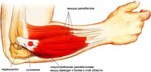 artrozė į alkūnės sąnario